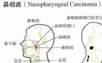 鼻咽癌的早期症状有哪些？