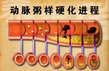 动脉粥样硬化