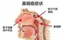 鼻咽癌有望靠疫苗预防控制