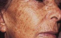 老人肝肾强 不长老年斑