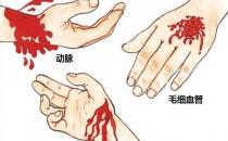 各种出血的急救方法