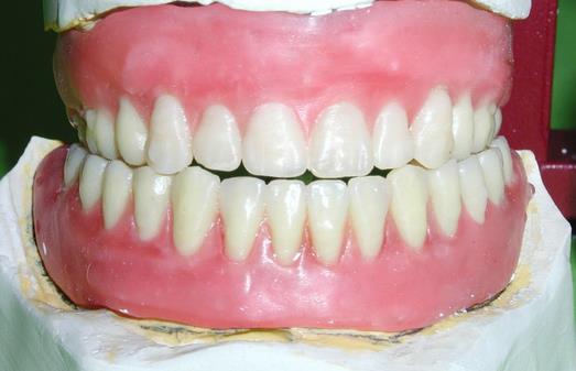 假牙的种类 老人怎样戴假牙安全健康