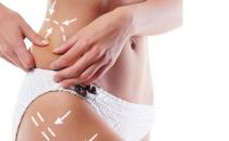 肥胖纹能不能去除呢