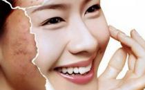 巧用妙招祛痘光滑肌肤常拥有