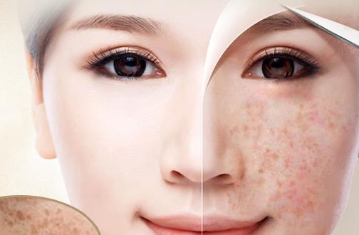 祛斑有新招:用什么洗脸能祛斑