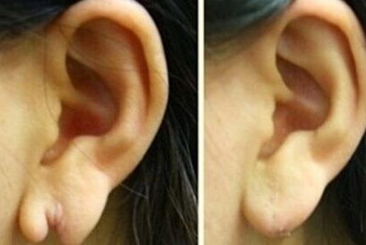 耳垂再造能解决哪些耳垂问题？