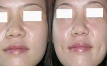 人造酒窝的切口有多大？