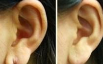 耳垂再造能解决哪些耳垂问题？