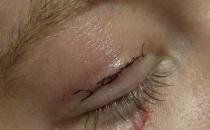 你真的适合做双眼皮术吗