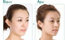 自体软骨隆鼻尖整形手术效果怎样？