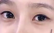 眼袋可不是卧蚕 它是怎么形成的