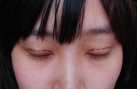 韩式双眼皮效果是永久的吗（韩式双眼皮是永久的吗?）