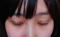 韩式双眼皮效果是永久的吗