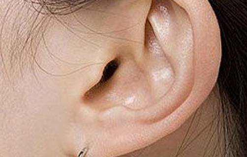 5种耳部畸形需要做整形（耳朵畸形整形）