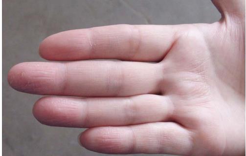 手脚脱皮有效食疗