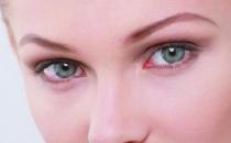 眼部整形消肿法 告别水泡眼