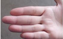 手脚脱皮有效食疗