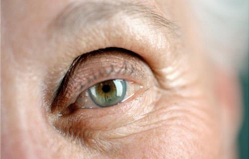 老年人突然眼皮下垂要警惕糖尿病