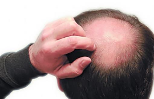 男人秃顶易患癌 6类食物让男人远离秃顶