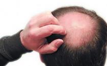 男人秃顶易患癌 6类食物让男人远离秃顶