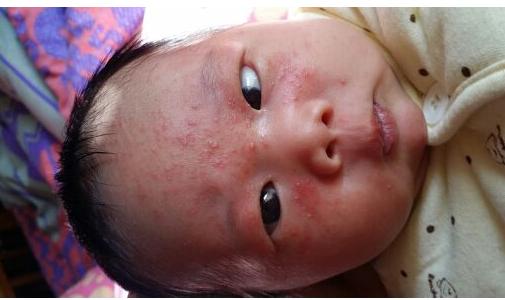 湿疹宝宝勤换尿布少洗澡