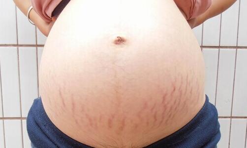 专家支招,如何预防和去除妊娠纹