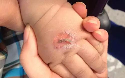 孩子常见的意外损伤类型有哪些?