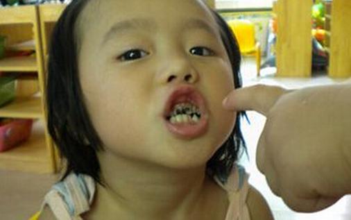 断奶太晚宝宝易发生龋齿