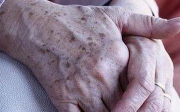 老年斑_老年斑的消除方法,老年斑的形成原因,老年斑的治疗偏方