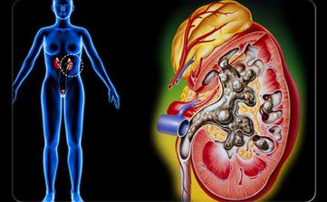 【肾结石】肾结石是怎么形成的_肾结石症状_肾结石治疗方法_肾结石偏方