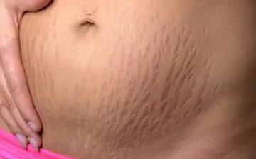 【妊娠纹】怎样去妊娠纹小窍门_孕妇妊娠纹图片_有什么办法去掉妊娠纹