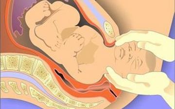 【难产】孕妇难产是什么症状_难产注意什么_难产为什么要剖腹产