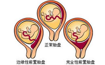 【胎盘】胎盘什么时候形成_胎盘的功效与作用_胎盘可以吃吗 【胎盘】胎盘什么时候形成_胎盘的功效与作用_胎盘可以吃吗