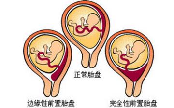 【胎盘】胎盘什么时候形成_胎盘的功效与作用_胎盘可以吃吗