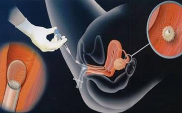 【人工受孕】人工受孕多少钱_人工受孕与试管婴儿有什么不同_人工受孕成功率 【人工受孕】人工受孕多少钱_人工受孕与试管婴儿有什么不同_人工受孕成功率