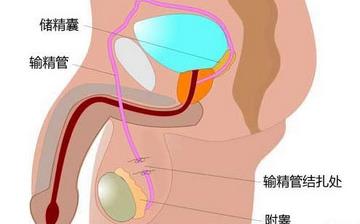 【男性结扎】男性结扎手术_结扎手术对男性的影响_男性结扎注意什么 【男性结扎】男性结扎手术_结扎手术对男性的影响_男性结扎注意什么