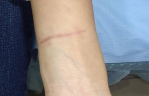 疤痕增生怎么办