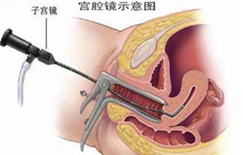 正确使用宫腔镜 患有哪些疾病不可用宫腔镜