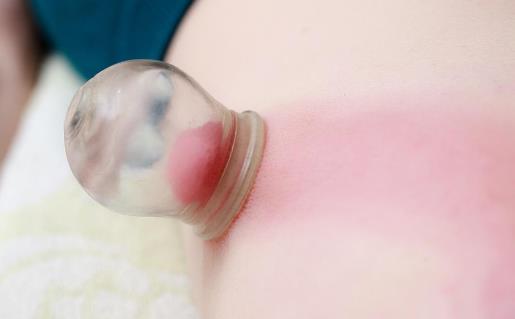 拔火罐帮你治疗冬季疾病