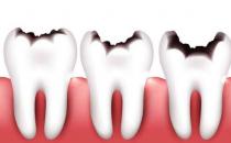牙齿衰老的症状你知道么？