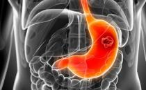 胃癌的发病原因有哪些
