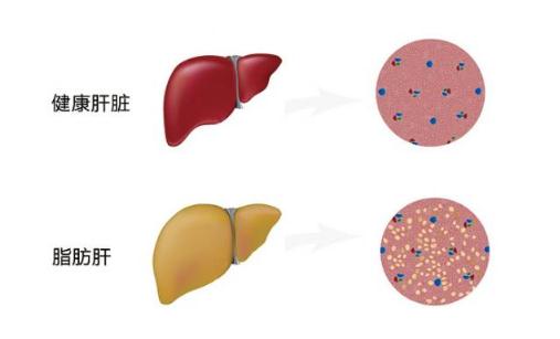 脂肪肝的治疗方法 应酬男应该看看