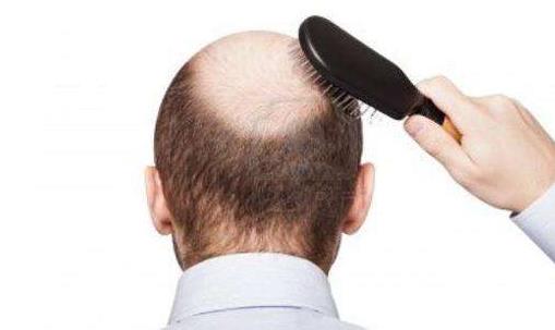 男人为什么容易掉头发 常换洗发水易脱发