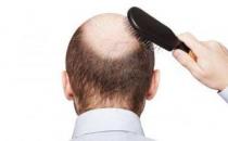 ​男人为什么容易掉头发 常换洗发水易脱发