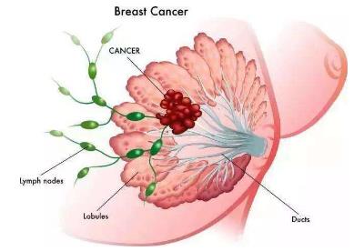 乳腺纤维瘤能不能治好？乳腺纤维瘤三级严重吗