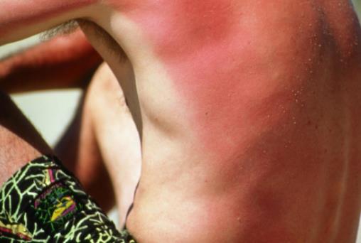 春季易引发的皮肤病 几种方法助你轻松应对