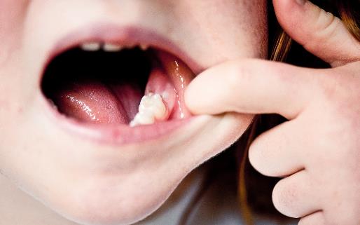 导致磨牙的因素 治疗磨牙要心理和药物治疗双管齐下