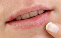 唇部疱疹是病毒性皮肤病 唇部疱疹初期泡内液体增多