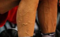 身上青筋凸起预示疾病风险 青筋暗示心血管疾病前兆