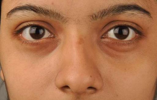 黑眼圈不仅是因为肾虚 黑眼圈透露你身体的健康问题